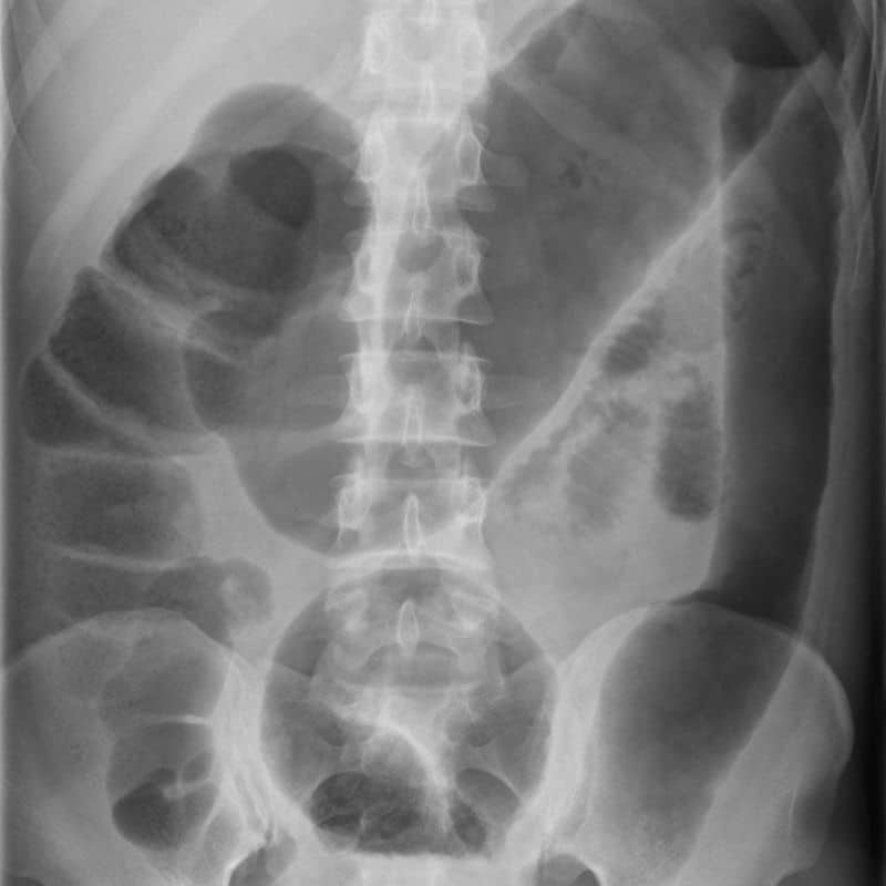 Radiografía de abdomen: cuándo realizarla, riesgos y beneficios