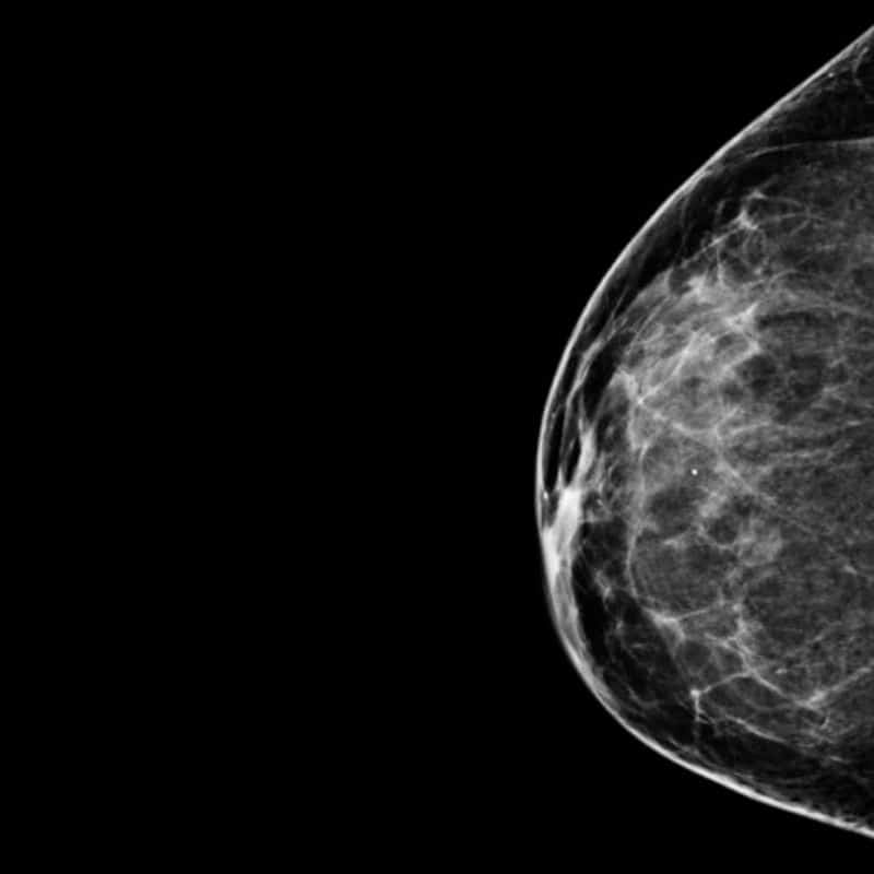 Comprar mamografía bilateral en Madrid, Barcelona, Sevilla, Zaragoza y más.