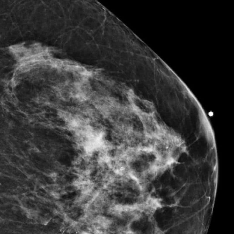 Comprar mamografía unilateral para la detección y diagnóstico del cáncer de mama, entre otros cuadros clínicos.