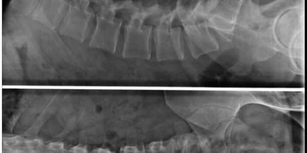 Radiografía de columna al mejor precio, en Zaragoza.