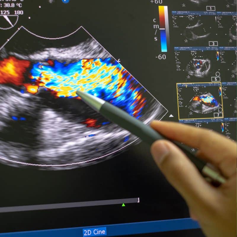Ecografía testicular doppler en Grupo VIVO.