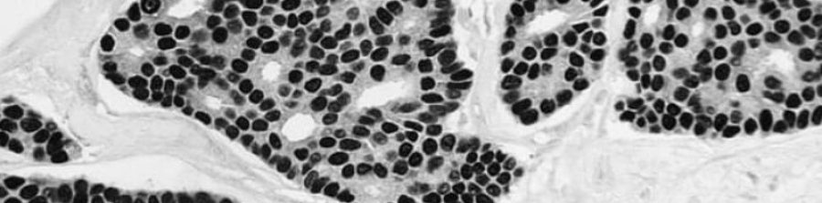 Biopsia guiada por estereotaxia, ejemplo.